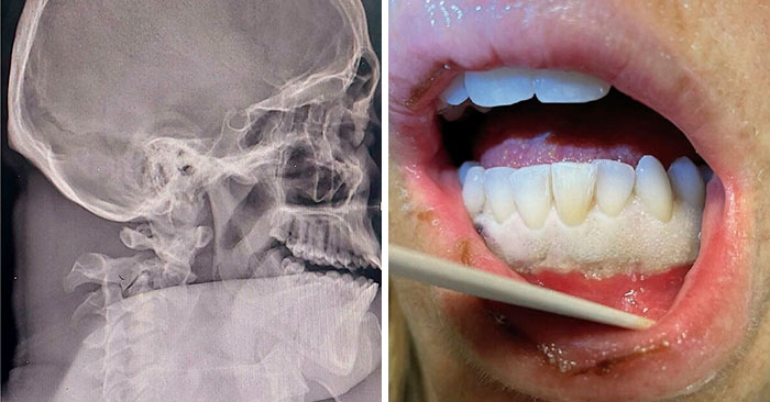 40 Bizarre And Inspiring Medical Cases That People Shared On This Online Community (New Pics)